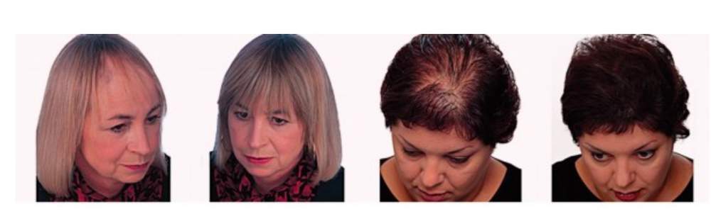 Coping with Partial Hair Loss Roches