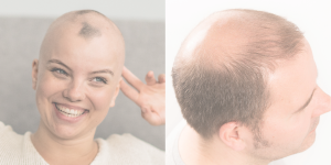 There are many types of alopecia, all of which Roches can assist with
